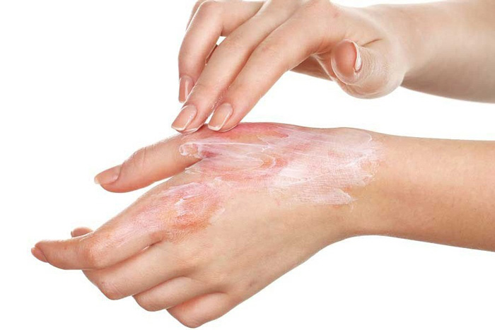 استفاده از کرم های آنتی بیوتیک یک روش مؤثر برای درمان سوختگی